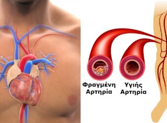 Φραγμένες αρτηρίες: 4 Σιωπηλά σημάδια ότι έχετε πρόβλημα απόφραξης στις αρτηρίες σας